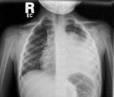 Upright chest radiograph in a 3-year-old child wit
