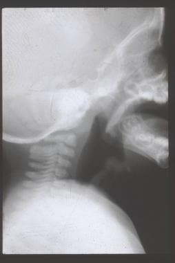 Radiograph of a child with acute epiglottitis; not