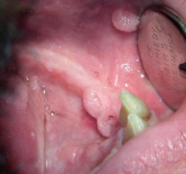 Multiple condylomas are seen in this HIV+ male wit