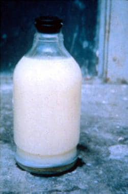 Urine from a patient with bancroftian filariasis d
