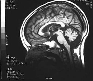 Magnetic resonance imaging study of the brain in a
