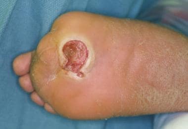 Open ulceration in diabetic foot after infection h
