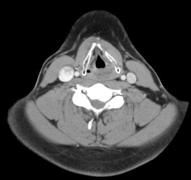 Axial-enhanced CT scan of the neck at the level of