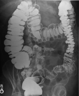 Hartmanns Procedure