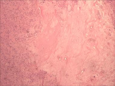 Pathology of Uterus Smooth Muscle Tumors. Hyaliniz