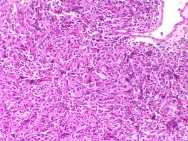 Paraganglioma of the urinary bladder. Microscopic 