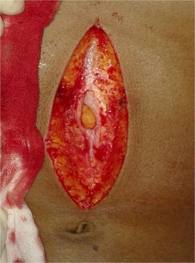 Linea alba is divided to reveal preperitoneal fat.