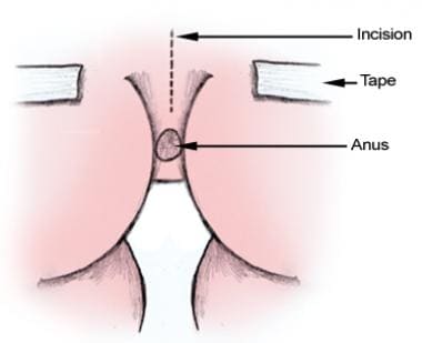Coccygectomy: surgical technique. 