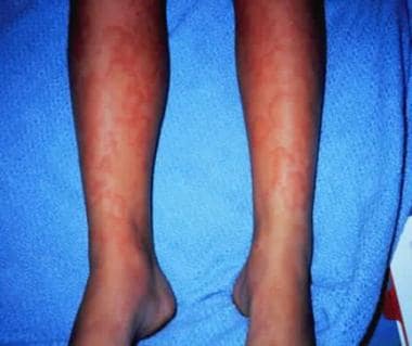 Urticaria associated with a drug reaction. 