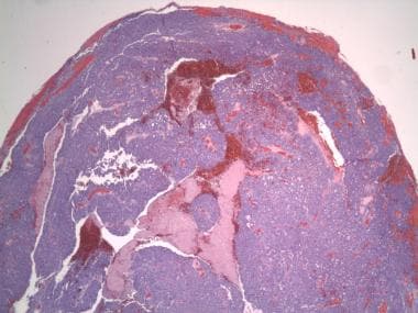 Pathology of Sebaceous Carcinoma. Irregular lobule