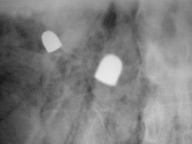 Radiograph showing identical projectiles with diff