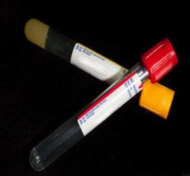 Photograph of a red-top and serum-separator (SST)