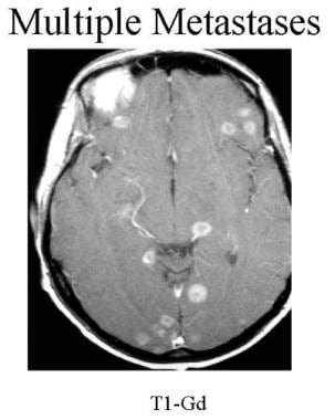 Axial contrast-enhanced T1-weighted MRI of a patie