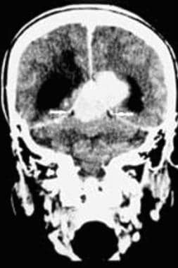 Posterior tentorial meningioma on a coronal contra