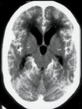 Axial contrast-enhanced CT of a child with tubercu