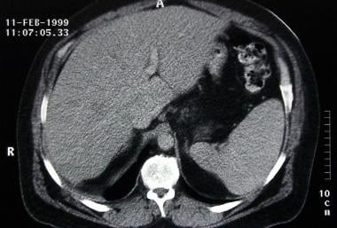 Constrictive pericarditis. The liver in this CT sc