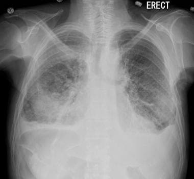 Chest radiograph in a patient with prostate cancer