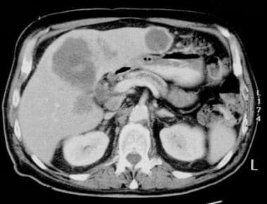 Computed tomography scan in a 65-year-old man. Thi