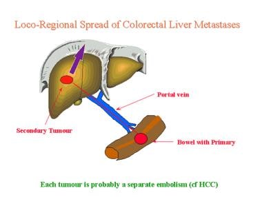 Liver, metastases. Diagram showing the mechanism o