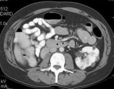 Case 6. Multifocal renal cell carcinoma in a patie