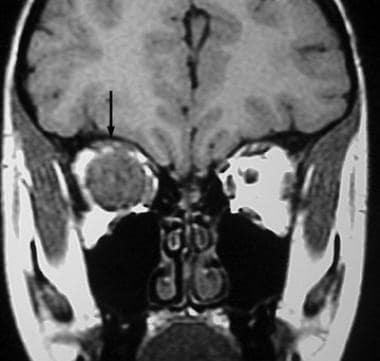 Coronal noncontrast T1-weighted MRI reveals a larg