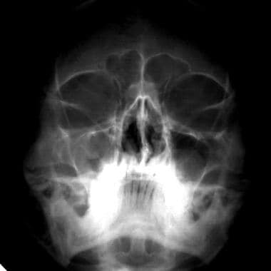 Polypoid mucosal thickening in the right maxillary
