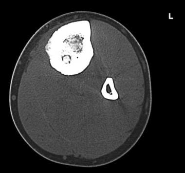 Transaxial CT scan in a 20-year-old man with osteo