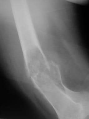Lateral radiograph of the distal femur in an adult