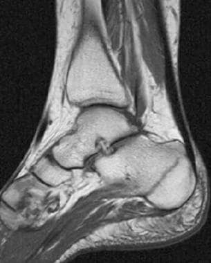 stress fracture x ray tibia