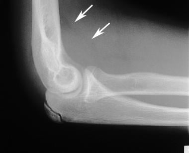 Lateral elbow radiograph in a patient with hemophi