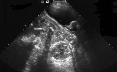 Transabdominal sonogram of an intrauterine pregnan