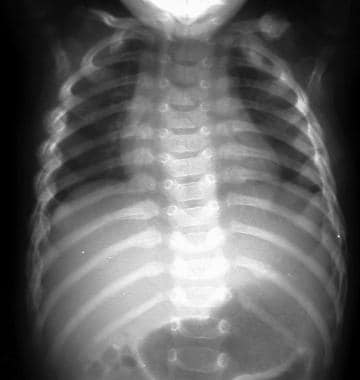 Rib Fracture. Image shows multiple bilateral rib f