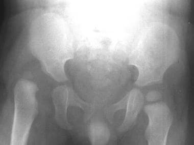 Frontal radiograph of the pelvis in a 1-year-old c
