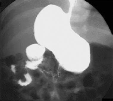 Midgut Volvulus X Ray