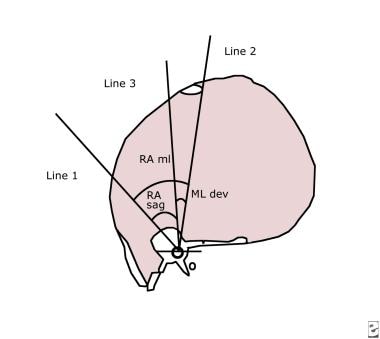 Line diagram illustrates measurement of the CT ind