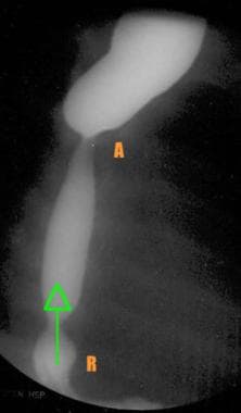 Barium esophagogram obtained in a patient 3 weeks 