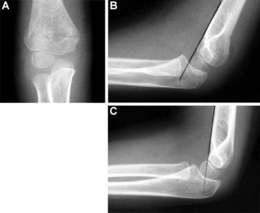 Typical supracondylar fracture. Fracture is obviou