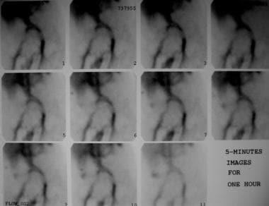 Technetium-99m (99mTc) red blood cell scan shows a