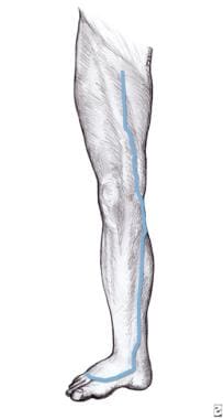 Saphenous Vein Cutdown Background Indications Contraindications