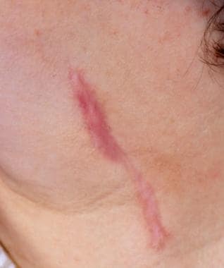 Hypertrophic scarring and keloids. Hypertrophic sc