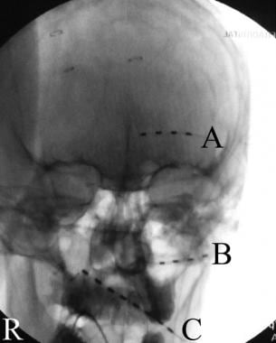 A fluoroscopic images of occipital leads in the su