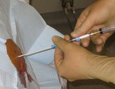 Paracentesis. Stabilization of needle and syringe.