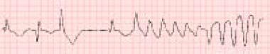 Terfenadine is the antihistamine most commonly ass