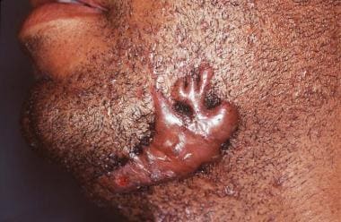 Scar, Keloid Scar