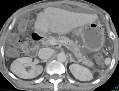 C-4: Splenic vein thrombosis of the same patient i