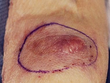 Large, violaceous nodule of Merkel cell carcinoma 