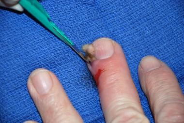 Wound opened with a small incision using a number-