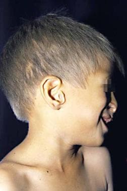 ectodermal dysplasia hair