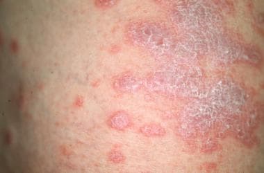 mayo clinic lichen planus