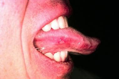 The tongue has an ulcer with an erythematous halo.